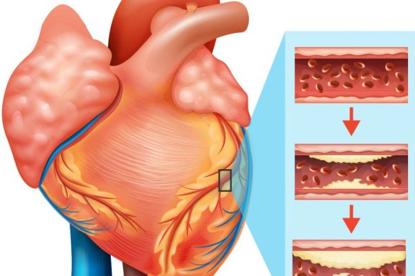 HeartDiseases_axen_analytics